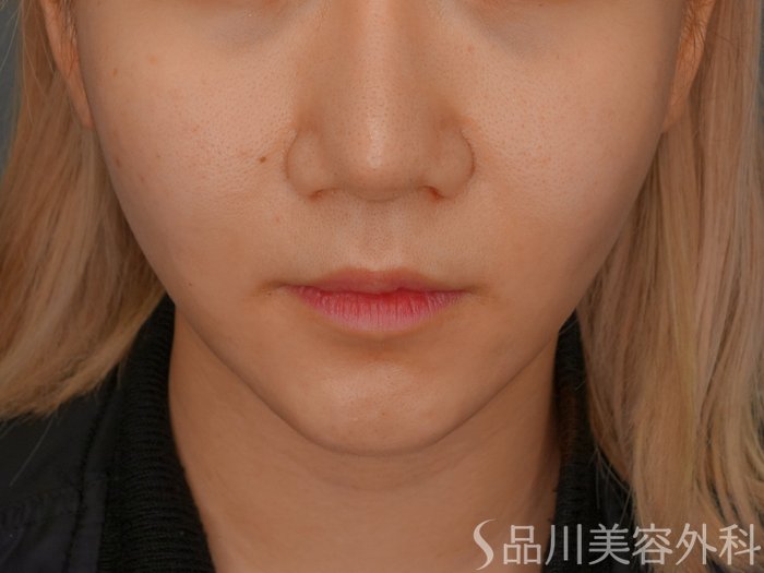 症例NO.73285のAFTER写真