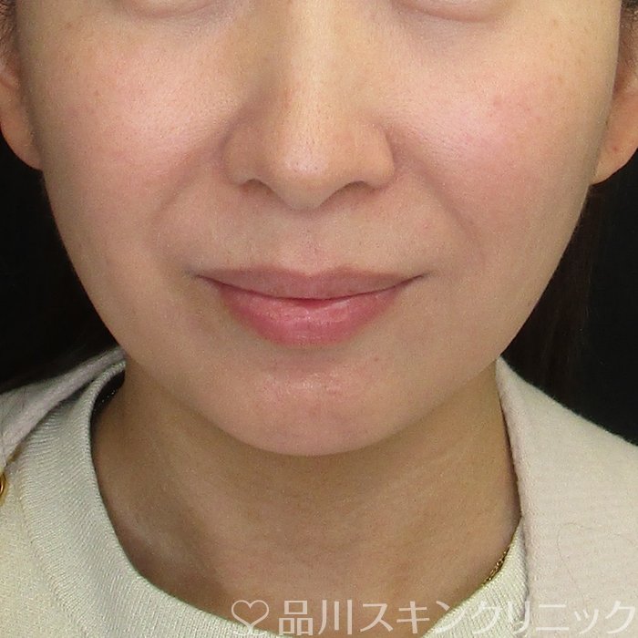 症例NO.73414のBEFORE写真