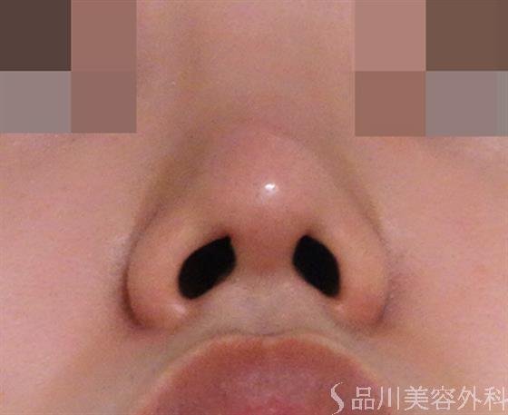 症例NO.40272のAFTER写真