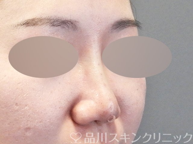 症例NO.64674のAFTER写真