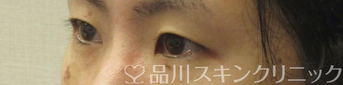 症例NO.73935のBEFORE写真