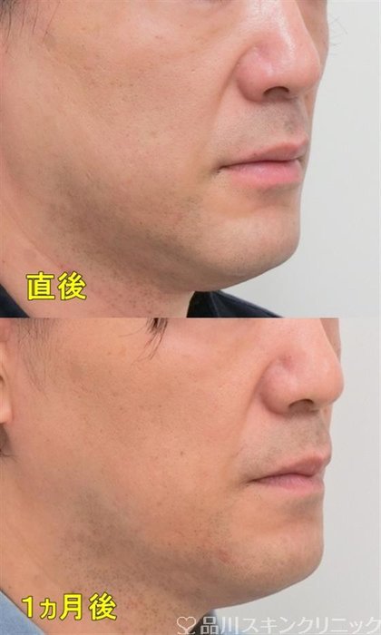 症例NO.29222のAFTER写真