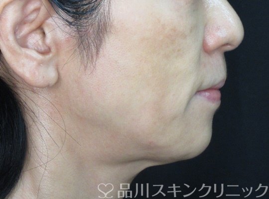 症例NO.71866のBEFORE写真