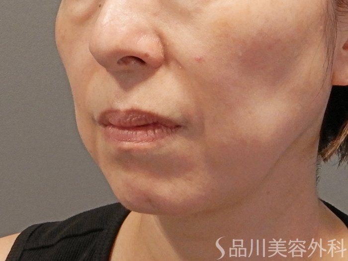 症例NO.72002のBEFORE写真