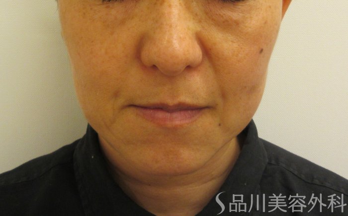 症例NO.74187のBEFORE写真