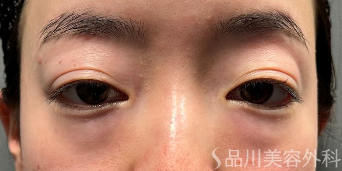 症例NO.72838のBEFORE写真