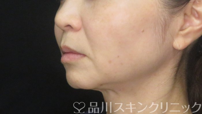 症例NO.72623のBEFORE写真