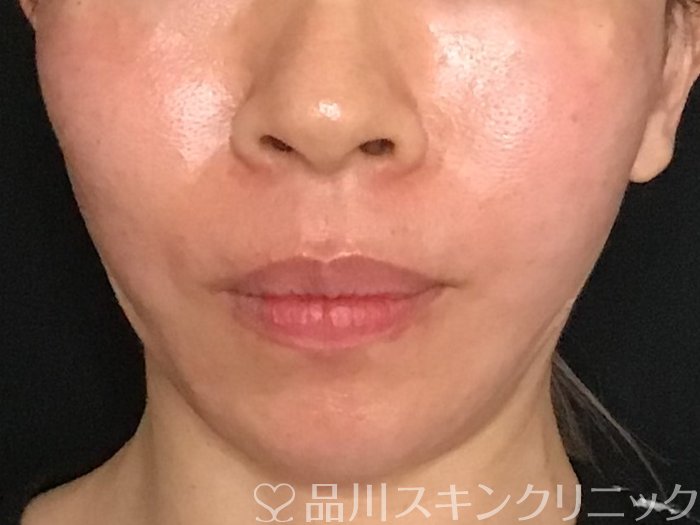 症例NO.65126のAFTER写真