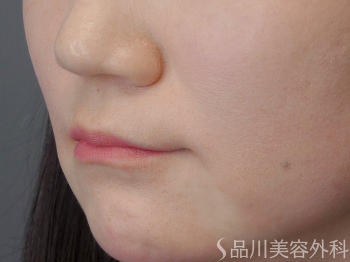 症例NO.72504のAFTER写真