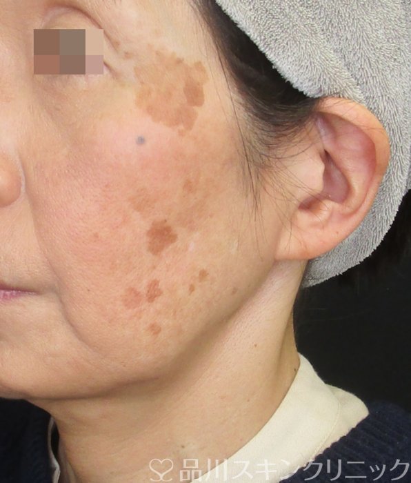 症例NO.73482のBEFORE写真