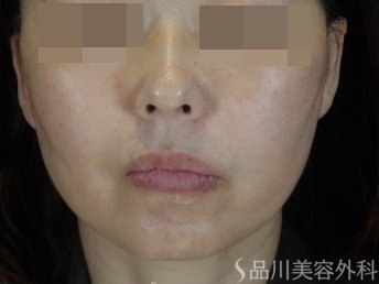 症例NO.74701のAFTER写真