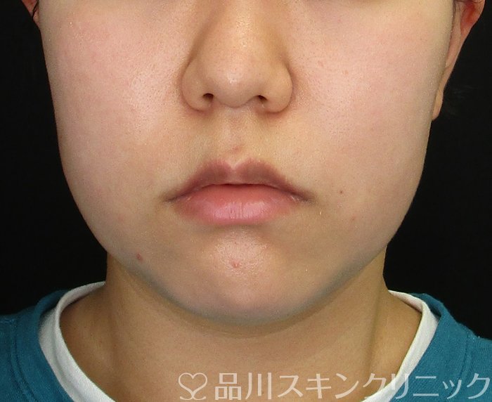 症例NO.75267のBEFORE写真