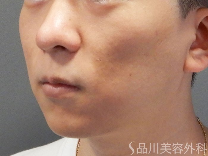 症例NO.73628のBEFORE写真