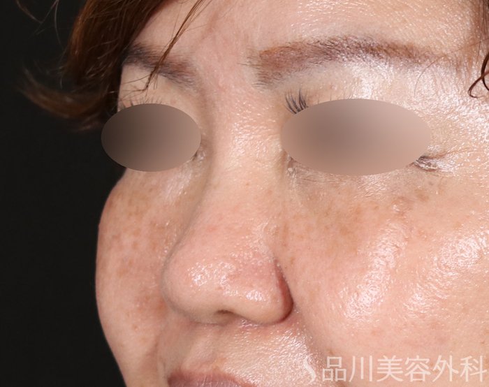 症例NO.71542のBEFORE写真