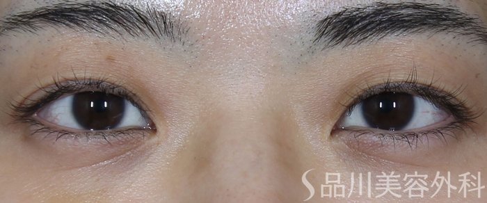 症例NO.71482のBEFORE写真