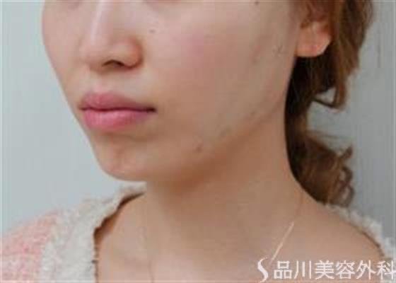 症例NO.47381のAFTER写真