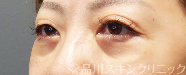 症例NO.72694のAFTER写真