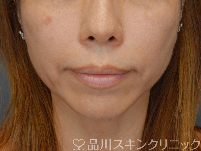 症例NO.70987のBEFORE写真
