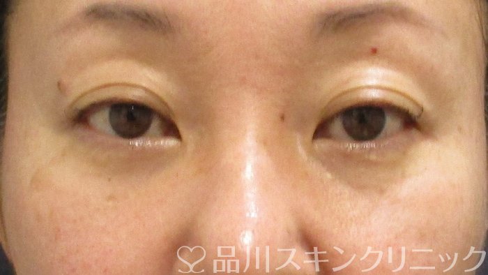 症例NO.69675のAFTER写真