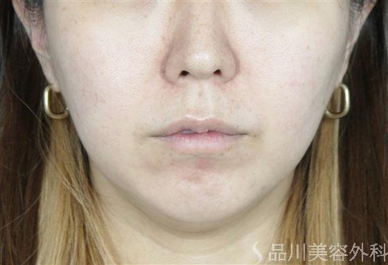 症例NO.61819のAFTER写真
