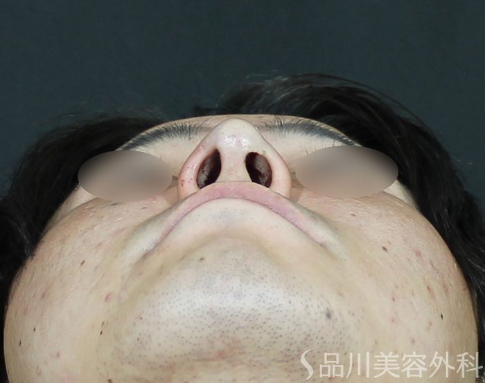 症例NO.65112のAFTER写真