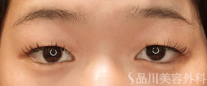 症例NO.70396のBEFORE写真