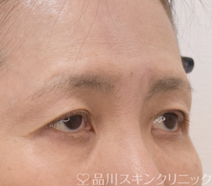 症例NO.71384のBEFORE写真