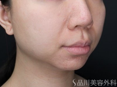 症例NO.69388のBEFORE写真