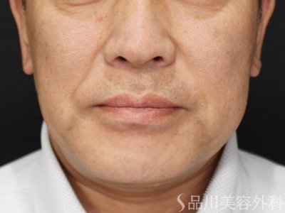 症例NO.73195のBEFORE写真