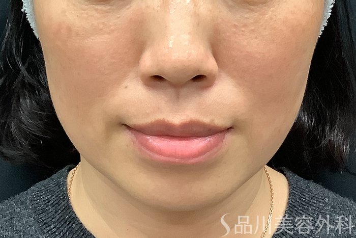 症例NO.73314のBEFORE写真