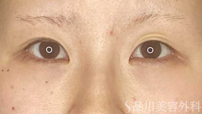 症例NO.69493のBEFORE写真