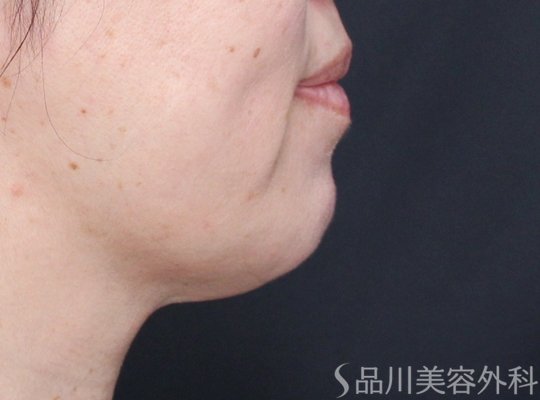 症例NO.72228のAFTER写真