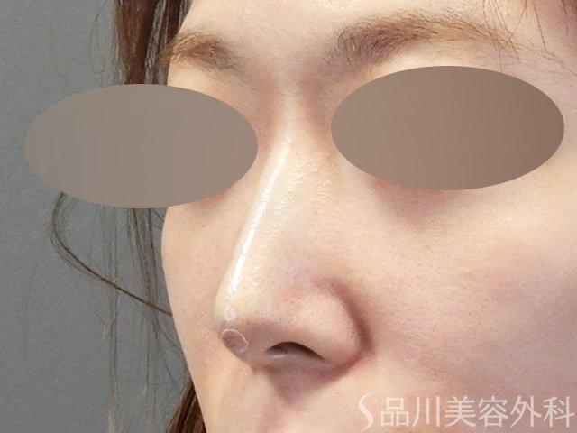 症例NO.64935のAFTER写真