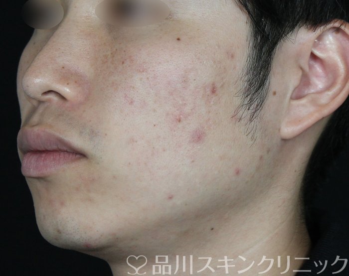 症例NO.68314のBEFORE写真