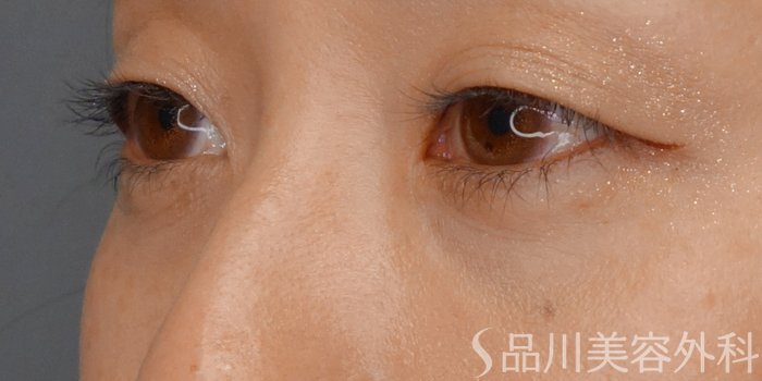症例NO.70369のAFTER写真