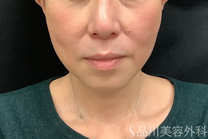症例NO.71293のAFTER写真