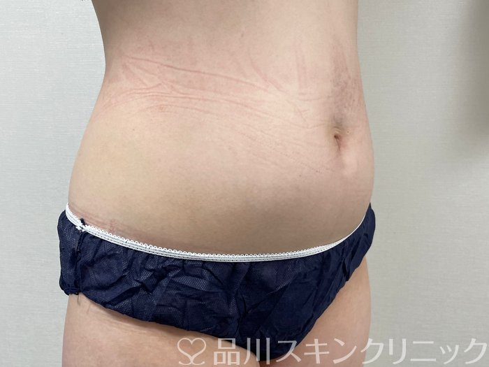 症例NO.74485のBEFORE写真