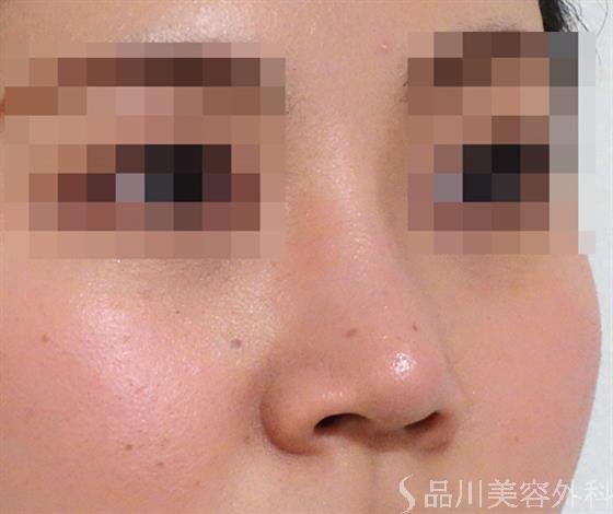症例NO.36512のAFTER写真
