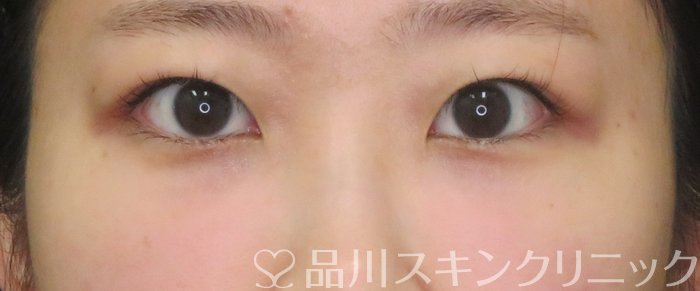 症例NO.74860のAFTER写真
