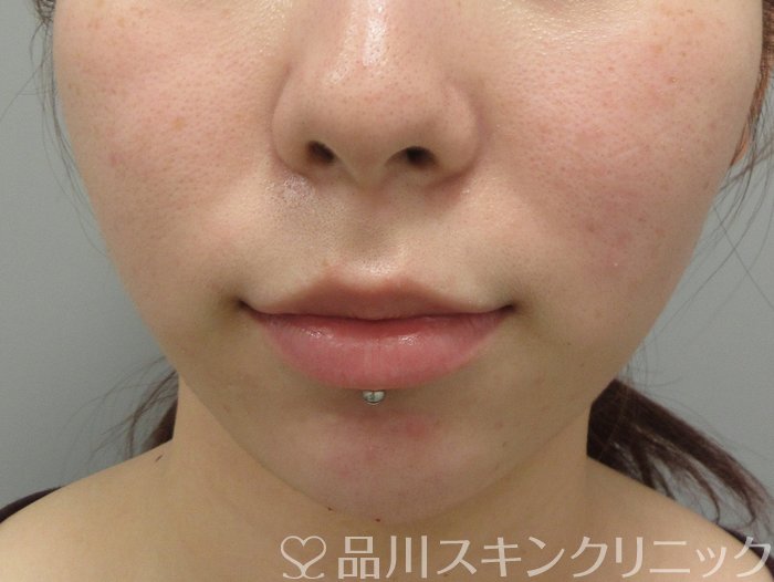 症例NO.70218のAFTER写真