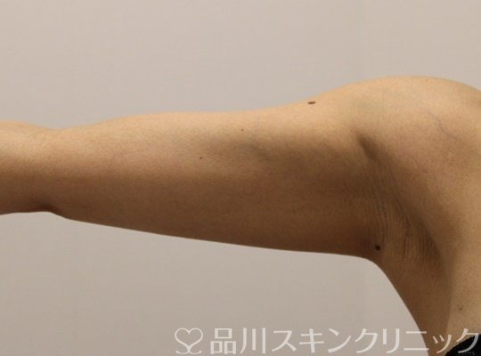 症例NO.72277のAFTER写真