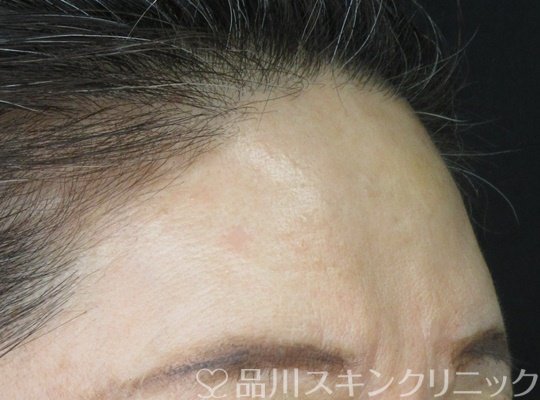 症例NO.70484のAFTER写真