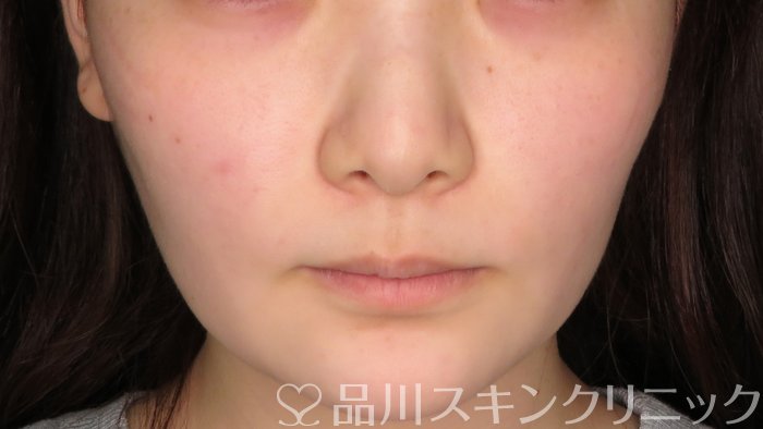 症例NO.71092のBEFORE写真