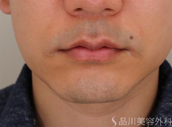 症例NO.48132のBEFORE写真