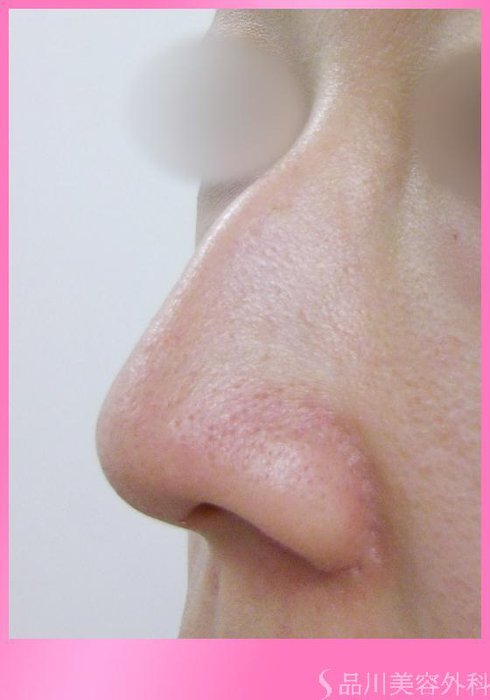 症例NO.3226のBEFORE写真