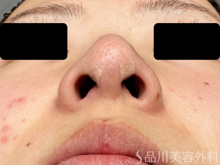 症例NO.74868のAFTER写真