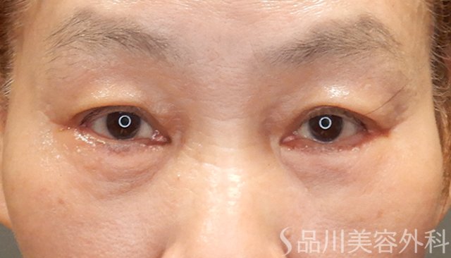 症例NO.74810のAFTER写真