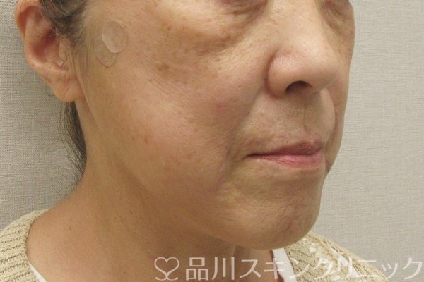 症例NO.75072のAFTER写真