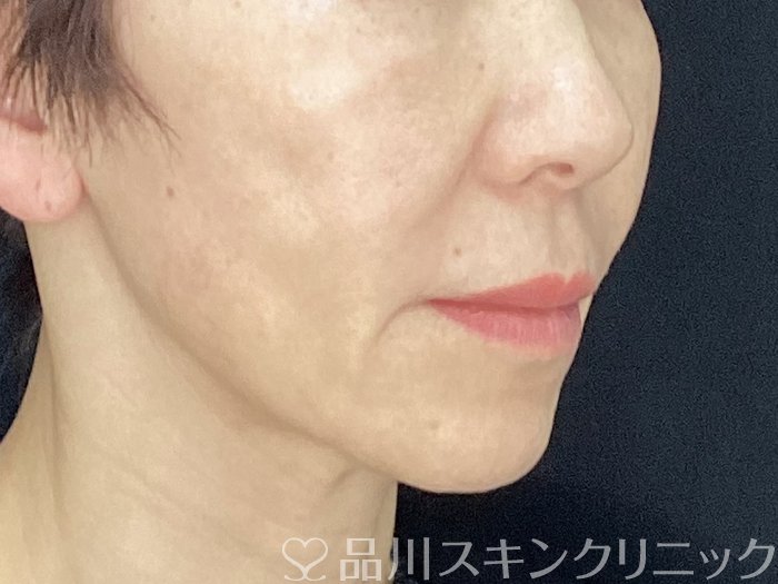 症例NO.71411のBEFORE写真