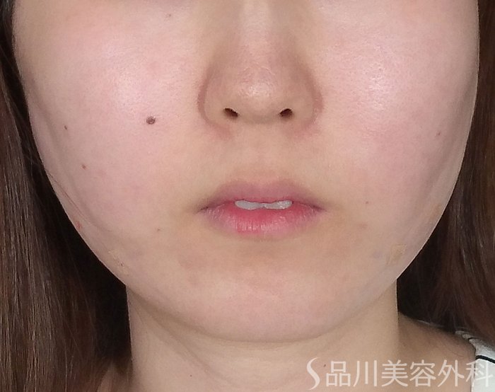 症例NO.65099のAFTER写真